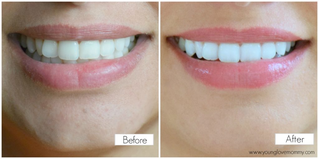 smile brilliant teeth whitening system plus giveaway